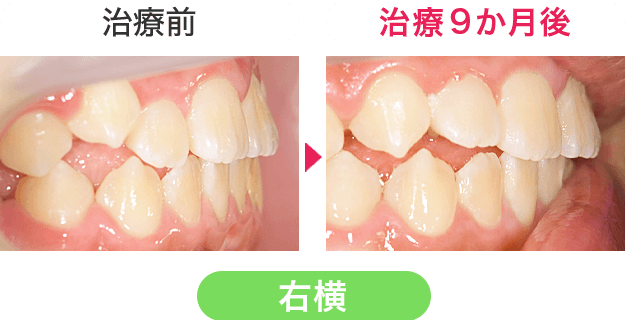 治療前後の口内写真